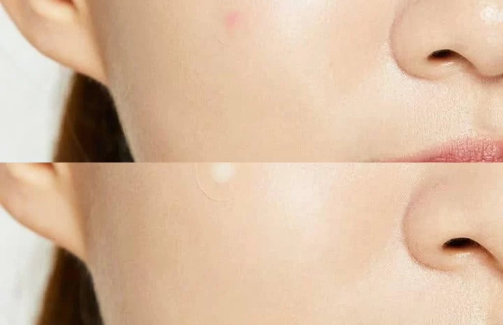 COSRX Acne Pimple Master Patch