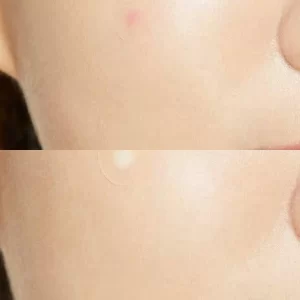 COSRX Acne Pimple Master Patch